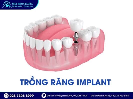 Phương pháp trồng răng giả nào tốt nhất hiện nay? - ảnh 3