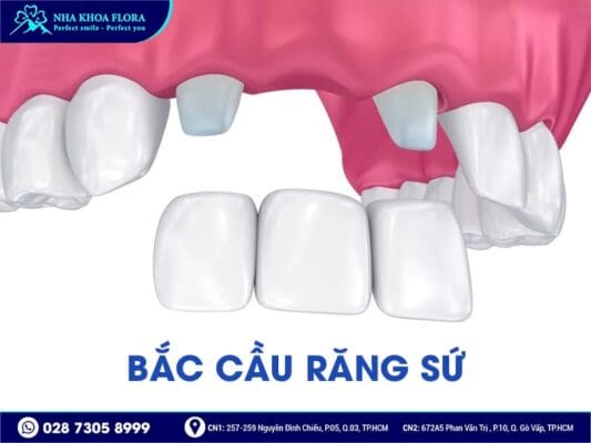 Phương pháp trồng răng giả nào tốt nhất hiện nay? - ảnh 4