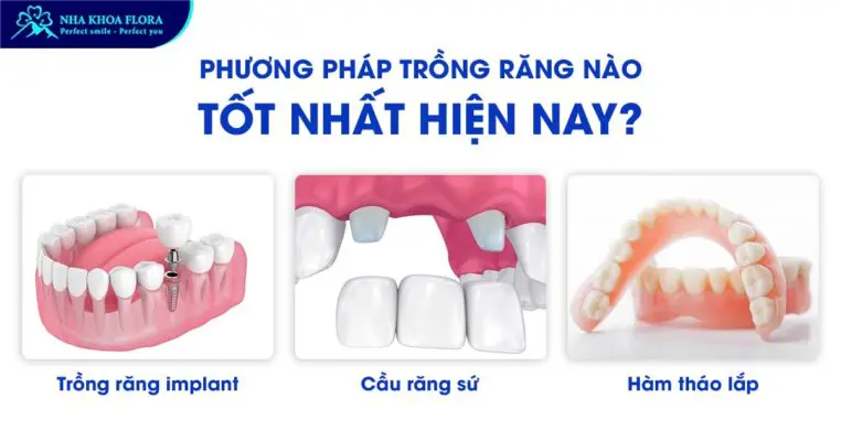 Trồng răng giả loại nào tốt? Giá bao nhiêu tiền? 3
