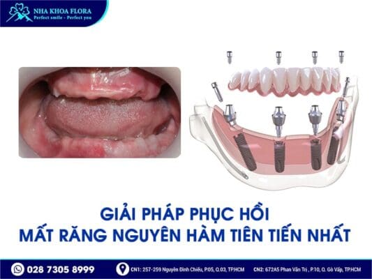 trồng răng nguyên hàm - ảnh 2