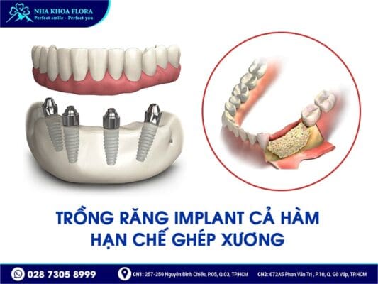 trồng răng nguyên hàm - ảnh 3