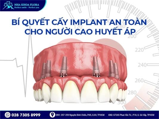 Cao huyết áp có cấy ghép Implant được không - ảnh 3