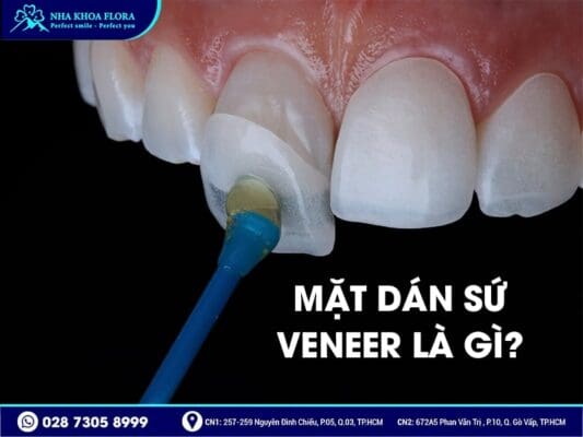 dán sứ Veneer - ảnh 1