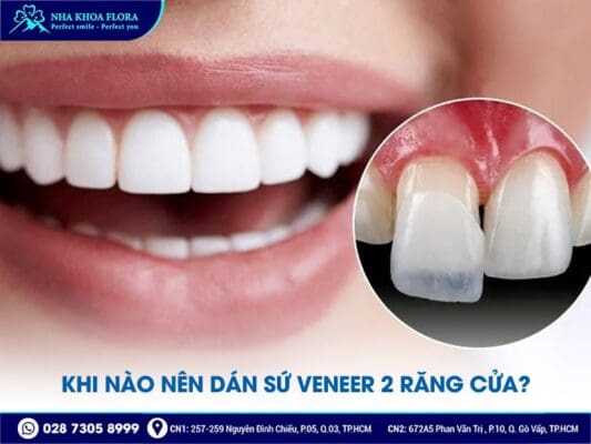 dán sứ Veneer 2 răng cửa - ảnh 1