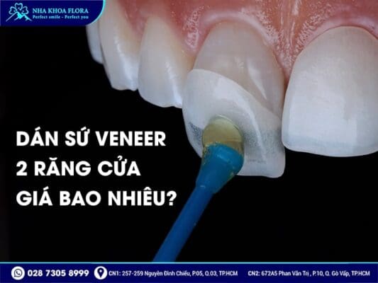 dán sứ Veneer 2 răng cửa - ảnh 3