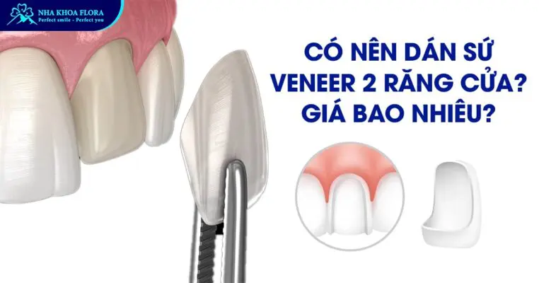 Có nên dán sứ Veneer 2 răng cửa? Giá bao nhiêu? 1