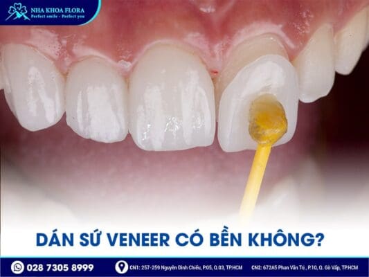 dán sứ Veneer - ảnh 2