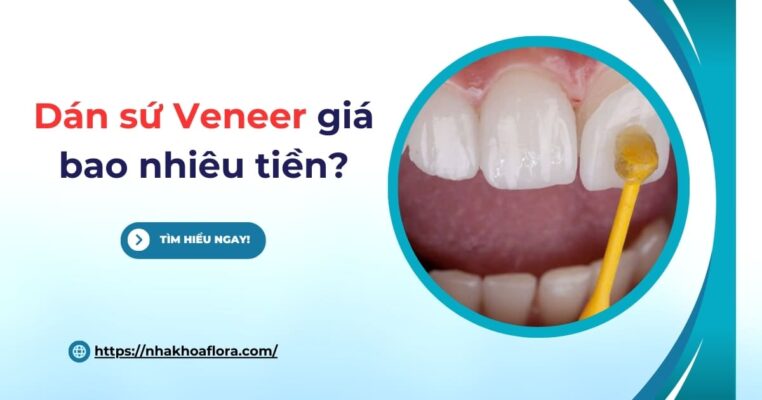 dán sứ veneer giá bao nhiêu