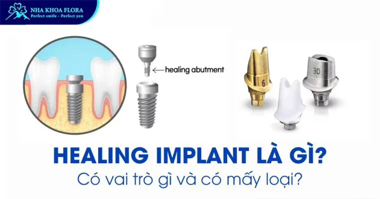 Healing Implant là gì? Có Vai Trò Gì Và Có Mấy Loại? 1