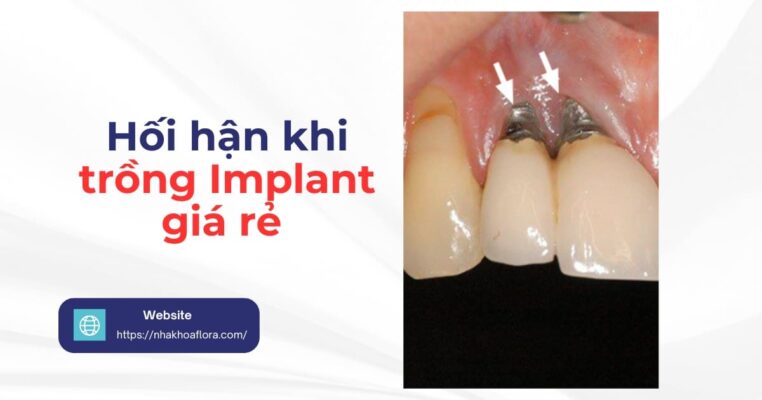 Hối hận khi trồng Implant