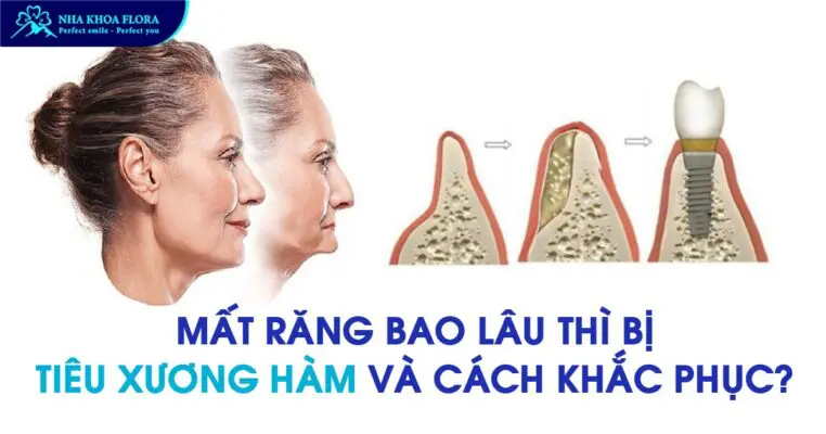 Mất răng bao lâu thì bị tiêu xương hàm và cách khắc phục? 2