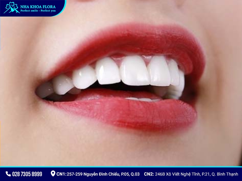mẫu răng sứ đẹp