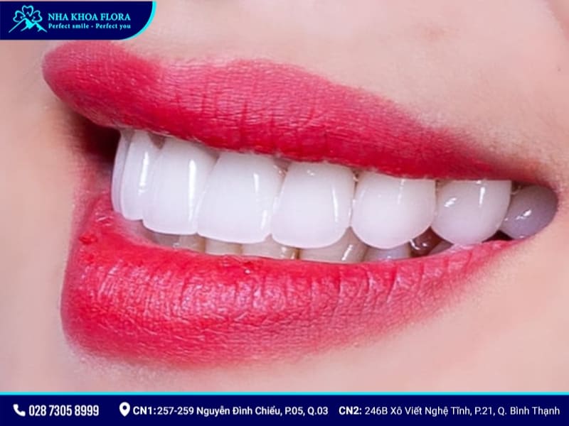 mẫu răng sứ đẹp