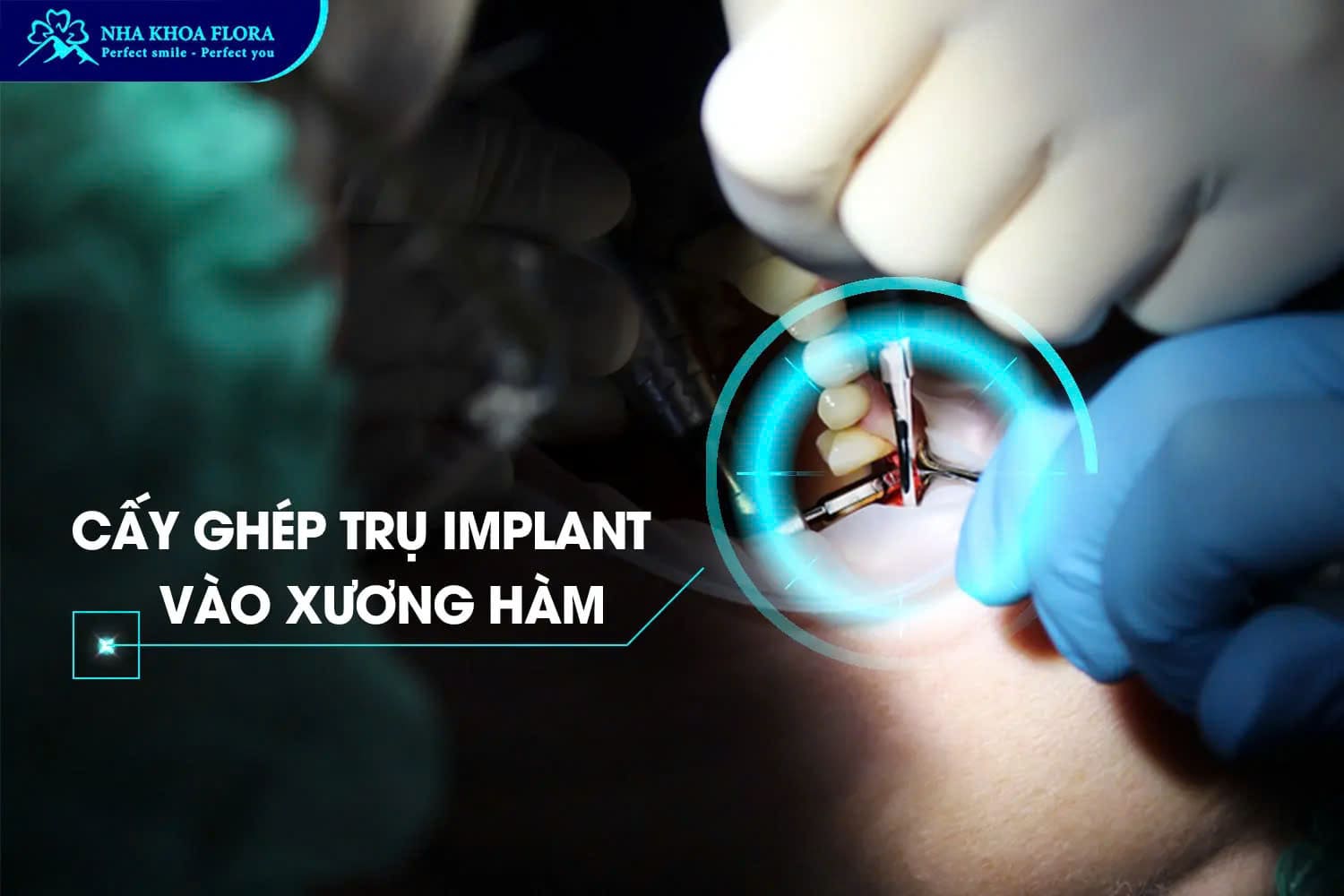 Bước 2: Cấy ghép trụ Implant vào xương hàm