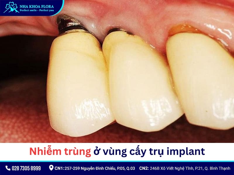Ngăn ngừa viêm nhiễm ở vị trí cấy ghép Implant