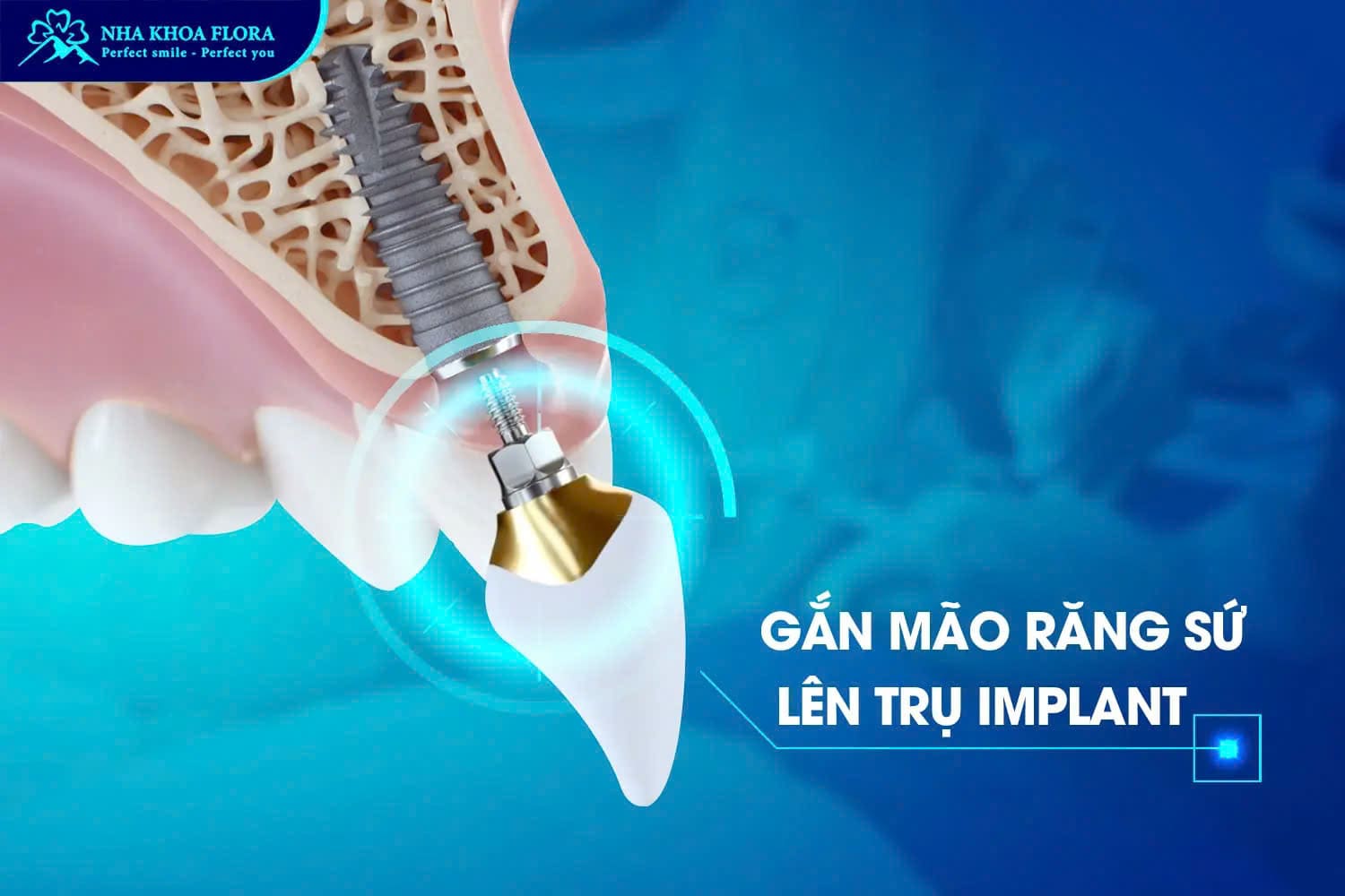 Bước 5: Lắp răng sứ hoàn tất quy trình trồng răng Implant