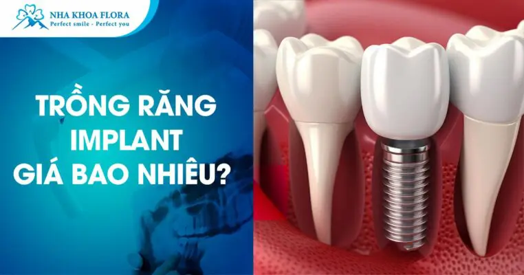 Trồng Răng Implant Giá Bao Nhiêu? - Nha Khoa Flora 4