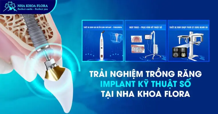 Nha khoa Flora – Đón đầu xu hướng trồng răng Implant kỹ thuật số 5