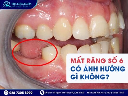 trồng răng hàm số 6 giá bao nhiêu - ảnh 1 trồng răng hàm số 6 giá bao nhiêu - ảnh 1