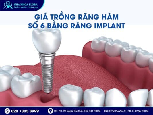 trồng răng hàm số 6 giá bao nhiêu - ảnh 3 trồng răng hàm số 6 giá bao nhiêu - ảnh 3