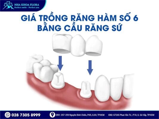 trồng răng hàm số 6 giá bao nhiêu - ảnh 4 trồng răng hàm số 6 giá bao nhiêu - ảnh 4