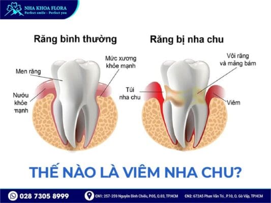 Viêm nha chu có cấy ghép implant được không - ảnh 1