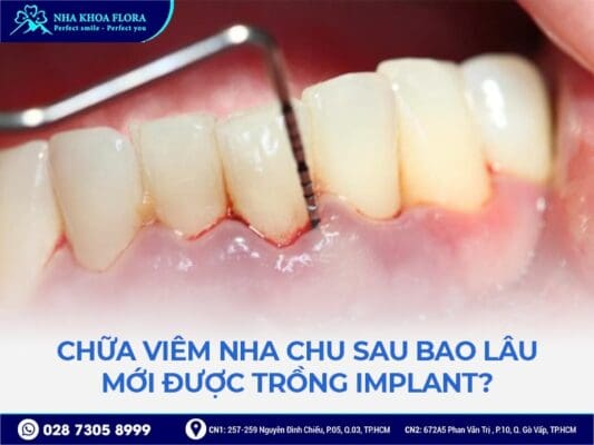 Viêm nha chu có cấy ghép implant được không - ảnh 3