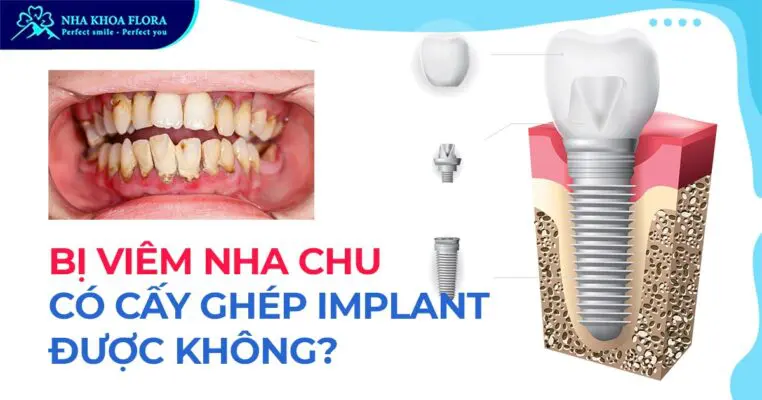 Bị viêm nha chu có cấy ghép Implant được không? 1
