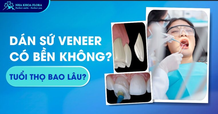 dán sứ veneer có bền không