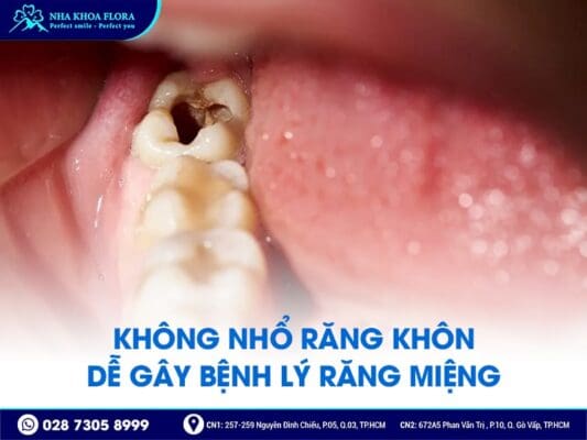 không nhổ răng khôn có sao không - ảnh 2 không nhổ răng khôn có sao không - ảnh 2