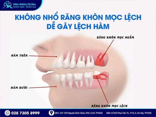 không nhổ răng khôn có sao không - ảnh 3 không nhổ răng khôn có sao không - ảnh 3