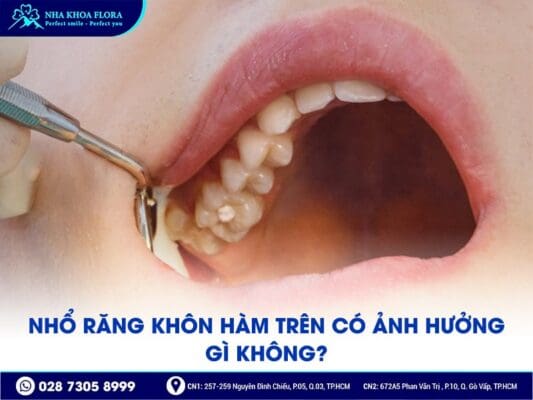 nhổ răng khôn hàm trên - ảnh 1