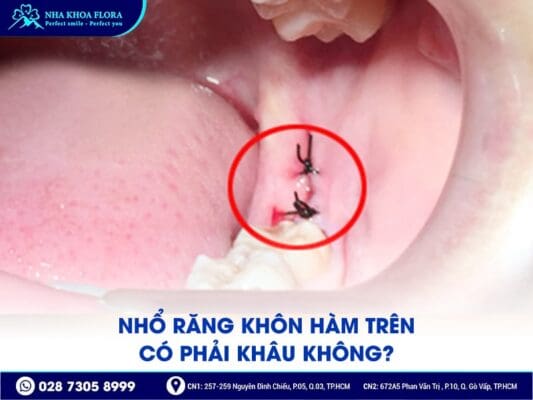 nhổ răng khôn hàm trên - ảnh 3