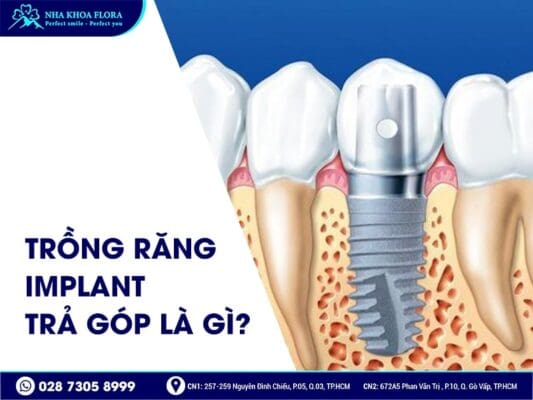 Trồng răng Implant trả góp - ảnh 1
