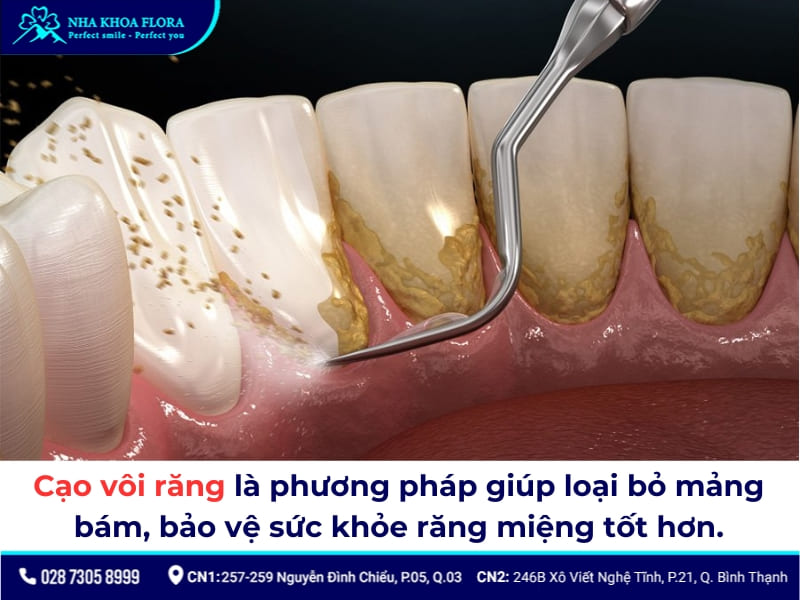 cạo vôi răng