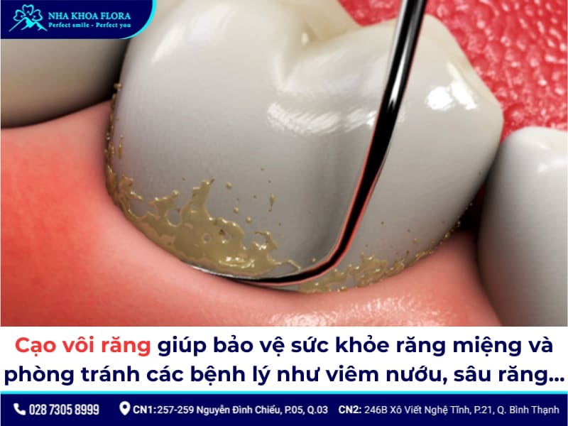 cạo vôi răng
