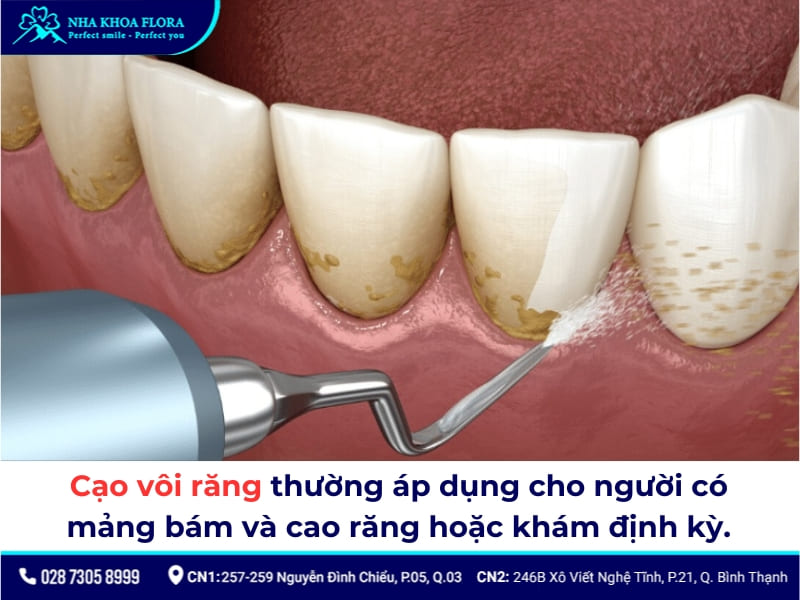 cạo vôi răng