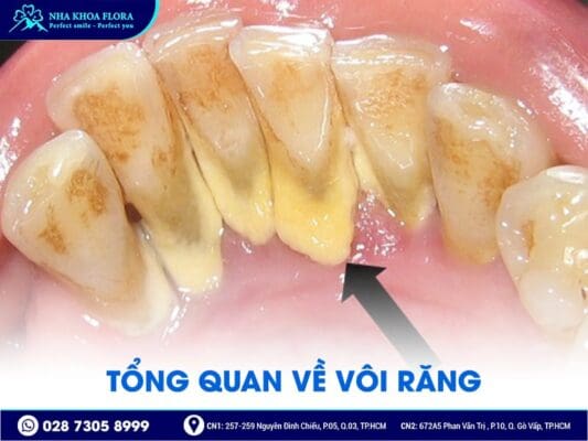 Cạo vôi răng có làm trắng răng không - ảnh 1