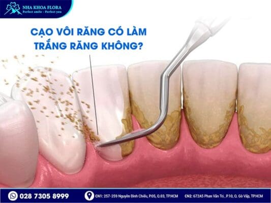 Cạo vôi răng có làm trắng răng không - ảnh 2