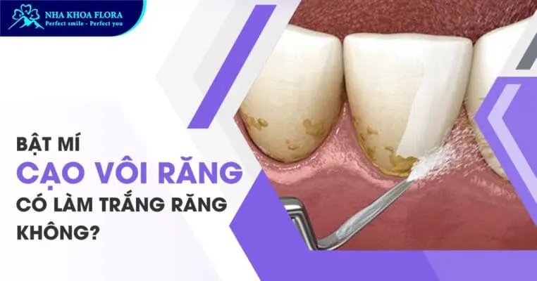 Bật mí cạo vôi răng có làm trắng răng không? 2