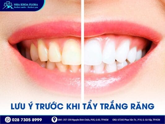 có nên tẩy trắng răng - ảnh 4