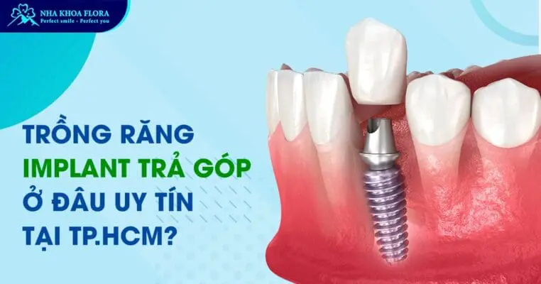 Trồng răng Implant trả góp ở đâu uy tín tại TP.HCM? 1