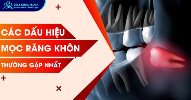 dấu hiệu mọc răng khôn