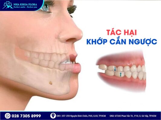 khớp cắn ngược - ảnh 3