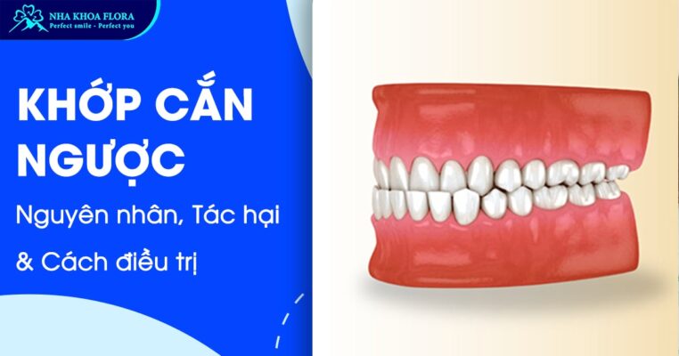 khớp cắn ngược