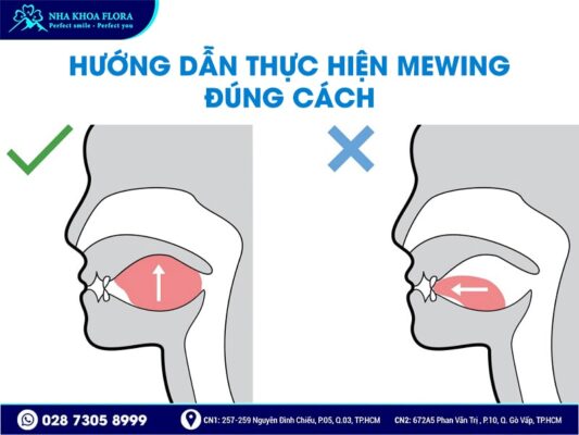 Mewing - ảnh 2 Mewing - ảnh 2
