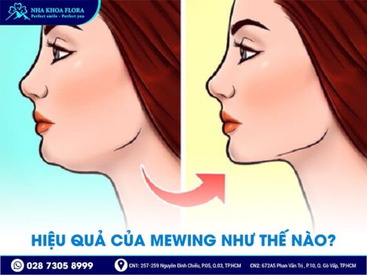 Mewing - ảnh 3 Mewing - ảnh 3