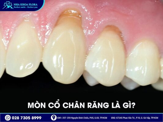 Mòn cổ chân răng - ảnh 1