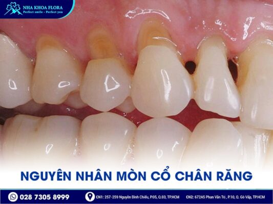 Mòn cổ chân răng - ảnh 2