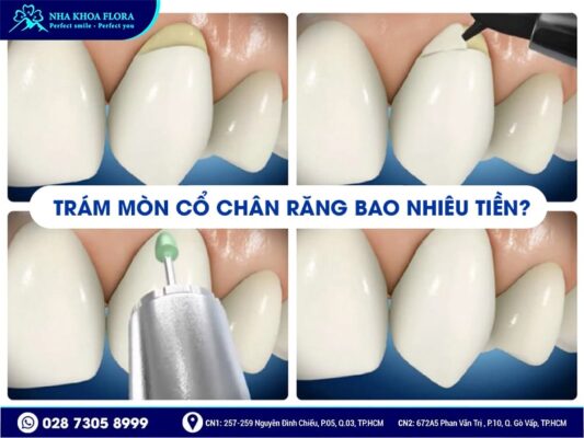 Mòn cổ chân răng - ảnh 4
